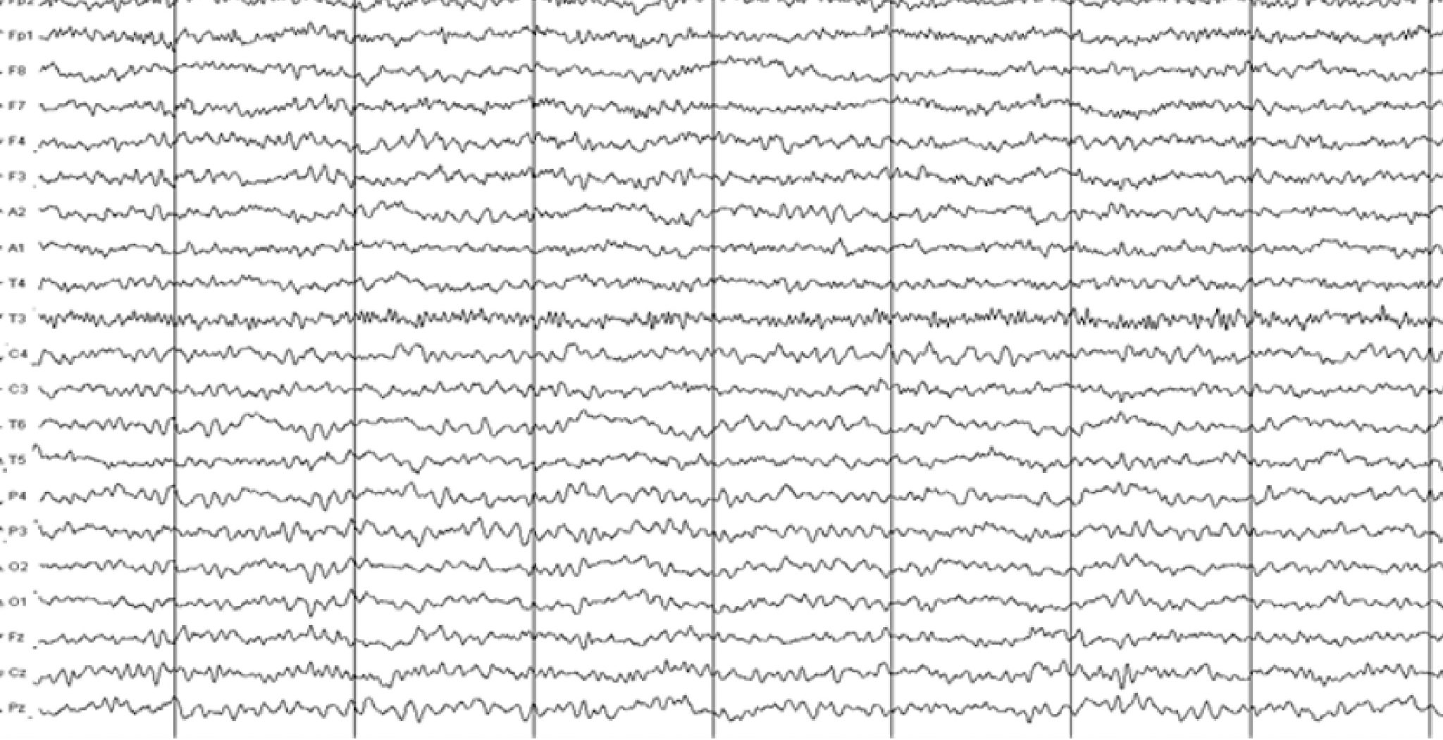 EEG without delirium