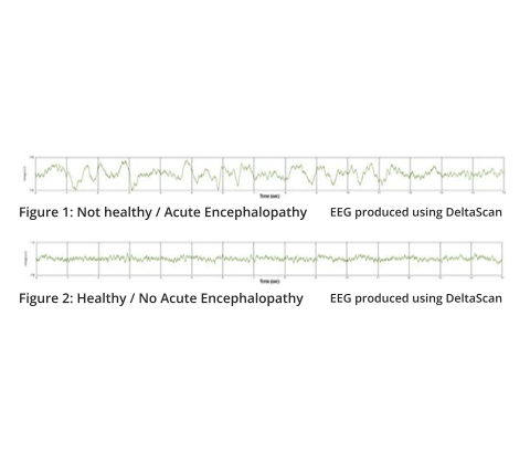 Validation Study EEG Acute Encephalopathy